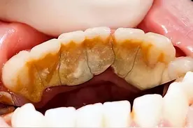 困扰我六七年的牙结石终于被我刷掉了！真后悔没有早点用它！图片