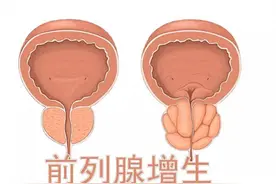 女科良药——桂枝茯苓汤，竟是斩断男性前列腺增生的利器！图片