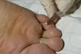 氟尿嘧啶注射治疗跖疣方法视频封面