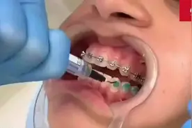 东莞儿童牙齿矫正——真人演示牙套制作过程视频封面