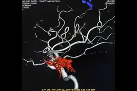 40秒了解岩下窦-海绵间窦入路治疗海绵窦区硬脑膜动静脉瘘视频封面