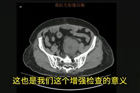 手把手带你看个CT腹部图像 女性，下腹疼痛