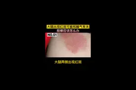 大腿两侧起红斑特别痒，可能还和脚气有关，股癣应该怎么办#科普 #股癣