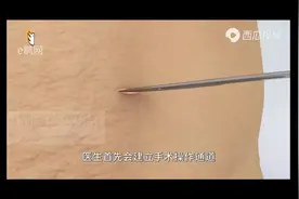 低位直肠癌手术高清动画#医学科普 #手术 #直肠癌#肠造口视频封面