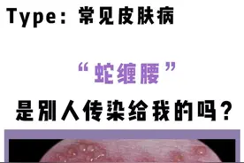 蛇缠腰不是别人传染给你的，但是一定要记住这几点！#樊哥撩皮肤 #蛇缠腰 #带状疱疹 #皮肤健康 视频封面