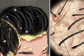 #热点助手 帅哥得了脂溢性皮炎，第一视角清理顽固头皮屑视频封面