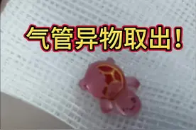 小儿气管异物除取出！ 可视化小儿气管异物除取出！#医学科普 #异物卡喉 #气管异物 #抖出健康知识宝藏 #手术日常