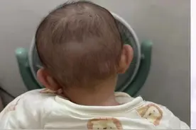 宝宝总歪头可能是斜颈！ 宝宝总歪头？可能是斜颈！斜颈分多种，可通过4大症状自查，0 - 12个月宝宝能热敷、松解、牵拉康复。治疗和预防的方法一个视频讲清楚。家长们千万别大意。#医疗健康创作训练营 #抖出健康知识宝藏#斜颈视频封面