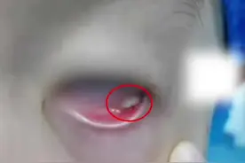警惕！7岁男孩猫毛入眼后长肉芽手术取出图片